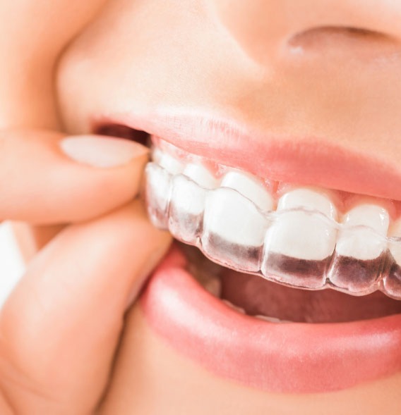 MyOrthoApeldoorn_Invisalign